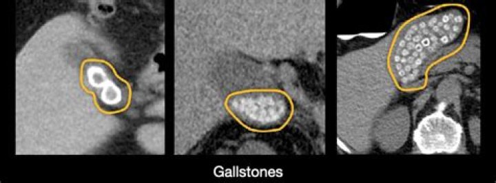 Would gallstones show up on a ct scan?